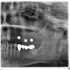 Ausgangssituation vor der geplanten Sinuslift OP im 2.Quadranten. Die Patientin wünscht eine spätere festsitzende, implantatgetragene Versorgung.