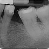 Regeneration des mesialen Knochendefektes am Zahn 36 ca. 1 Jahr nach der Straumann® Emdogain Behandlung