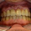 Das zahntechnische Endergebnis der Brücke, befestigt auf den Zähnen 12, 23 und 24 sowie auf dem Implantat 11. Zahn 25 (hier leider nicht sichtbar) ist mit einer einzelnen Zirkonkrone versorgt worden. Um den Knochendefekt abzudecken, war es hier ästhetisch notwendig im Dentallabor Zahnfleisch in Form von rosafarbigem Kunststoff anzubringen.