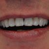 Die Zähne des Patienten nach dem Bleaching und Einsetzen des Veneers