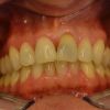 Die Zähne des Patienten vor der Behandlung: hier liegt eine innere Verfärbung des Zahnes 21 vor, ggf. verursacht durch eine Einblutung. Der Patient wünscht eine kosmetische Behandlung mit Veneers. Der Zahn ist noch vital.