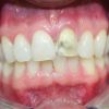 Zähne des Patienten nach dem Bleaching ohne Veneer: als Vergleichsfoto wurde hier das Provisorium nach dem Bleaching abgenommen.