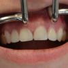 Die Zähne sind nun nach durchgeführter professioneller Zahnreinigung und Bleaching mit hochästhetischen Veneers versorgt worden.