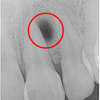 Entzündung der Wurzelspitze – Die Entzündung befindet sich rechts (im Fachbegriff: Distal) von der Wurzelspitze und ist deutlich als schwarzer Fleck erkennbar.