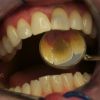Die Zähne des Patienten vor der Behandlung: hier Ansicht von palatinal.