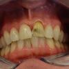 Die Zähne des Patienten während der Präparation: Der Zahn wird oberflächlich von der Außenseite reduziert zur Befestigung der hauchdünnen Keramikverblendschalen (Veneers). Hier wird nun auch immer mehr der eigentliche „Defekt“ sichtbar. Für die Übergangsphase bis zum Einsetzen des Veneers erhält der Patient ein Provisorium.