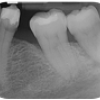 Mesialer Knocheneinbruch am Zahn 36 vor der Straumann® Emdogain Behandlung