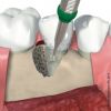 Der parodontale Defekt liegt nun frei und kann optimal von den vorhandenen Belägen befreit werden …