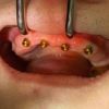 Nach erfolgreicher Freilegung der Implantate im Oberkiefer wurden die Sulkusformer eingebracht, die nun dafür sorgen, das Zahnfleisch optimal auszuformen.