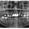 Ausgangssituation vor der geplanten Sinuslift und Implantat OP im 1.Quadranten regio 16 und der geplanten Implantat OP im 3.Quadranten regio 36.