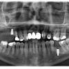 Röntgenbild post OP: die Implantate regio 16 und 36 sind deutlich sichtbar, regio 16 musste sogar minimal ein Sinuslift durchgeführt werden, ohne Augmentation.