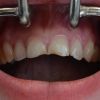 Die Zähne der Patientin vorher: durch Säureerosionen sind die Zähne stark geschädigt. Es sind Schneidekantenfrakturen sowie Verfärbungen erkennbar.